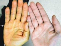 Ba biến đổi trên da cảnh báo bệnh ung thư gan