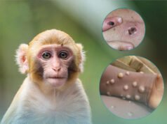 Cách chẩn đoán, điều trị và phòng bệnh đậu mùa khỉ theo hướng dẫn của Bộ Y tế!